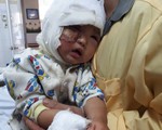 Bố đang nằm viện, bé 23 tháng tuổi ngã vào bếp lửa bị bỏng nặng khuôn mặt