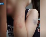 Hình ảnh đau lòng về thương tích của người vợ Việt vừa bị chồng Hàn đánh đập