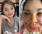 Rạch nhiều vết trên mặt để cứu cô gái trẻ ở Hà Nội tiêm mỡ tự thân làm đẹp
