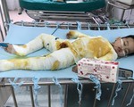 Xót xa bé trai 2 tuổi bị bỏng toàn thân do ngã vào nồi nước nóng