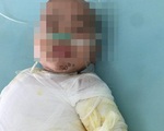 Bỏng nước sôi đơn giản, bé 1 tuổi vẫn qua đời, bác sĩ chỉ ra sai lầm của cha mẹ khi sơ cứu cho con bị bỏng