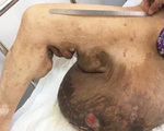 Người phụ nữ được cắt bỏ khối u khổng lồ 19 kg