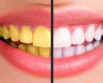 Ngạc nhiên với cách làm răng trắng bóng sạch đơn giản, rẻ tiền mà không phải dùng hóa chất