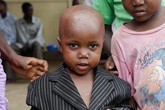 Bệnh nhân Ebola nhí "cầu hôn" với y tá chăm sóc Bệnh nhân Ebola nhí "cầu hôn" với y tá chăm sóc
