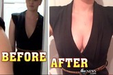 Chi nghìn đô để nâng ngực siêu tốc Chi nghìn đô để nâng ngực siêu tốc