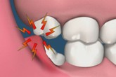 Tất cả những điều bạn cần biết về răng khôn Tất cả những điều bạn cần biết về răng khôn