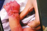 Mẹ tâm thần cắn nát tay con trai vừa sinh Mẹ tâm thần cắn nát tay con trai vừa sinh