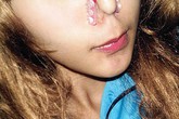 Quảng cáo kẹp nâng mũi chỉ là bịp bợm Quảng cáo kẹp nâng mũi chỉ là bịp bợm