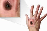 Cảnh báo bệnh than ở gia súc lây sang người Cảnh báo bệnh than ở gia súc lây sang người