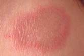 Điều trị bệnh vẩy phấn hồng Điều trị bệnh vẩy phấn hồng