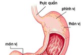 Cảnh giác với bệnh viêm loét hang vị dạ dày Cảnh giác với bệnh viêm loét hang vị dạ dày