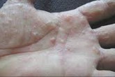Bệnh chàm tổ đĩa và cách trị bằng đông y Bệnh chàm tổ đĩa và cách trị bằng đông y