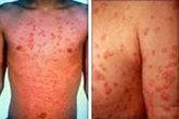 Hỏi đáp về bệnh vẩy nến thể giọt Hỏi đáp về bệnh vẩy nến thể giọt