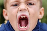 Lạ kỳ cậu bé có 4 hàm răng Lạ kỳ cậu bé có 4 hàm răng