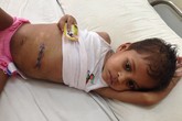 Bé 4 tuổi nhai suốt 9 tháng cuộn tóc dài 1,2m vào bụng Bé 4 tuổi nhai suốt 9 tháng cuộn tóc dài 1,2m vào bụng