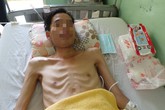 Đau bụng, chán ăn, vào bệnh viện mất 1,2 mét ruột Đau bụng, chán ăn, vào bệnh viện mất 1,2 mét ruột