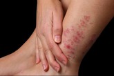 Dùng thuốc nào trị vảy nến hiệu quả? Dùng thuốc nào trị vảy nến hiệu quả?