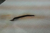 Kinh hãi đỉa dài gần 5cm bám sâu trong lỗ mũi Kinh hãi đỉa dài gần 5cm bám sâu trong lỗ mũi