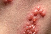 Mới sinh ra đã mắc bệnh giang mai Mới sinh ra đã mắc bệnh giang mai