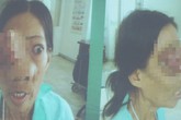 Cứu sống người phụ nữ bán vé số bị u xâm lấn não Cứu sống người phụ nữ bán vé số bị u xâm lấn não