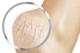 Nứt gót chân Chứng bệnh của mùa lạnh Nứt gót chân Chứng bệnh của mùa lạnh