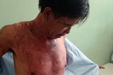 Bị đánh, vợ tạt cháo nóng vào chồng Bị đánh, vợ tạt cháo nóng vào chồng