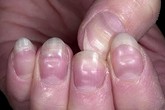 Móng tay cảnh báo bệnh tật Móng tay cảnh báo bệnh tật