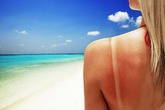 Cách bảo vệ bản thân khỏi ung thư da trong mùa hè Cách bảo vệ bản thân khỏi ung thư da trong mùa hè