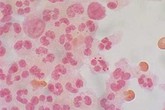 Cảnh giác với bệnh viêm não mô cầu Cảnh giác với bệnh viêm não mô cầu