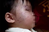 Bé 11 tháng tuổi bị bạn cắn, cào nát mặt khi đi nhà trẻ Bé 11 tháng tuổi bị bạn cắn, cào nát mặt khi đi nhà trẻ