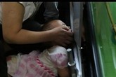 Kẹp tay vào thang cuốn, ngón tay bé gái bị đứt lìa Kẹp tay vào thang cuốn, ngón tay bé gái bị đứt lìa
