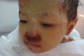 Bé 2 tuổi suýt chết vì đắp lá chữa bỏng Bé 2 tuổi suýt chết vì đắp lá chữa bỏng
