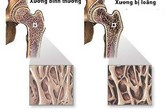 Bổ sung rất nhiều canxi vẫn bị loãng xương, tại sao? Bổ sung rất nhiều canxi vẫn bị loãng xương, tại sao?