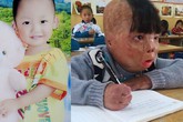 Hành trình 4 năm sống sót của cậu bé bị cha ruột đổ xăng đốt Hành trình 4 năm sống sót của cậu bé bị cha ruột đổ xăng đốt
