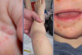 TP Hồ Chí Minh: Bệnh tay, chân, miệng khiến trẻ bị biến chứng thần kinh TP Hồ Chí Minh: Bệnh tay, chân, miệng khiến trẻ bị biến chứng thần kinh
