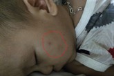 Bé trai 15 tháng tuổi bị bạo hành rất hoảng loạn, sốt và sợ người lạ Bé trai 15 tháng tuổi bị bạo hành rất hoảng loạn, sốt và sợ người lạ