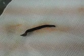 Gắp con đỉa dài 4,5 cm thập thò cửa mũi Gắp con đỉa dài 4,5 cm thập thò cửa mũi