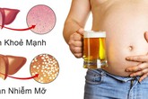 Cảnh giác với gan nhiễm mỡ nếu bạn ngồi nhiều Cảnh giác với gan nhiễm mỡ nếu bạn ngồi nhiều