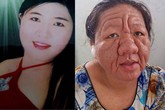 Cô gái 20 tuổi thành bà lão 70 vì tác dụng phụ của thuốc Cô gái 20 tuổi thành bà lão 70 vì tác dụng phụ của thuốc