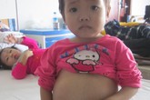 Nhờ độc giả GiadinhNet, bé 4 tuổi “bụng căng tròn” sắp được phẫu thuật cắt lá lách Nhờ độc giả GiadinhNet, bé 4 tuổi “bụng căng tròn” sắp được phẫu thuật cắt lá lách