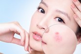 Bí quyết loại bỏ mụn trứng cá bọc Bí quyết loại bỏ mụn trứng cá bọc