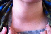 Hỏi và đáp về bệnh lý tuyến giáp Hỏi và đáp về bệnh lý tuyến giáp