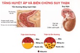 Bệnh tăng huyết áp có thể dẫn đến suy thận Bệnh tăng huyết áp có thể dẫn đến suy thận