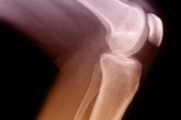Viêm khớp dạng thấp – Nguyên nhân gây bệnh Viêm khớp dạng thấp – Nguyên nhân gây bệnh