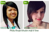 Gọt mặt V line và nhiều bước tiến mới Gọt mặt V line và nhiều bước tiến mới