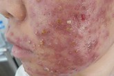 Hãi hùng “tiên dược làm đẹp” siêu rẻ và những hệ lụy khôn lường Hãi hùng “tiên dược làm đẹp” siêu rẻ và những hệ lụy khôn lường