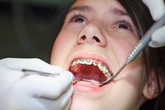 Bé gái rách môi do dụng cụ niềng răng Bé gái rách môi do dụng cụ niềng răng