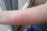 Dấu hiệu bệnh nguy hiểm từ mề đay Dấu hiệu bệnh nguy hiểm từ mề đay