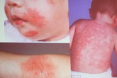Làm gì để trẻ ít dị ứng khi trưởng thành? Làm gì để trẻ ít dị ứng khi trưởng thành?