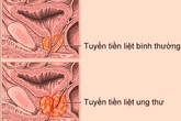 Điều trị thành công ung thư bằng phương pháp cấy hạt phóng xạ Điều trị thành công ung thư bằng phương pháp cấy hạt phóng xạ
